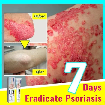 Мехлем за отстраняване на псориазис, Екзема, Псориазис, най-Добрите средства срещу псориазного дерматит, Натурални растителни екстракти При псориазис
